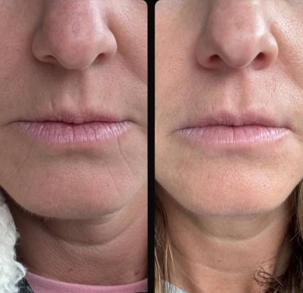 Vertical Lip Lines  | Skinvive | Case 1 