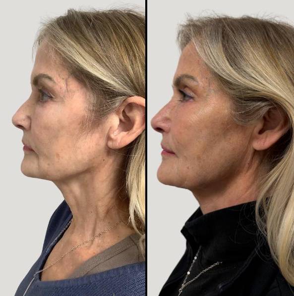 Lasers for Face | CO2 | Case 1 