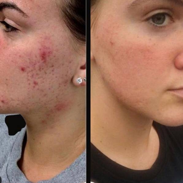 Lasers for Acne | Genesis | Case 1 