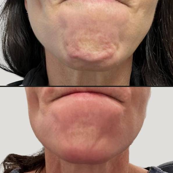 Injectables for Chin | Botox | Case 5 