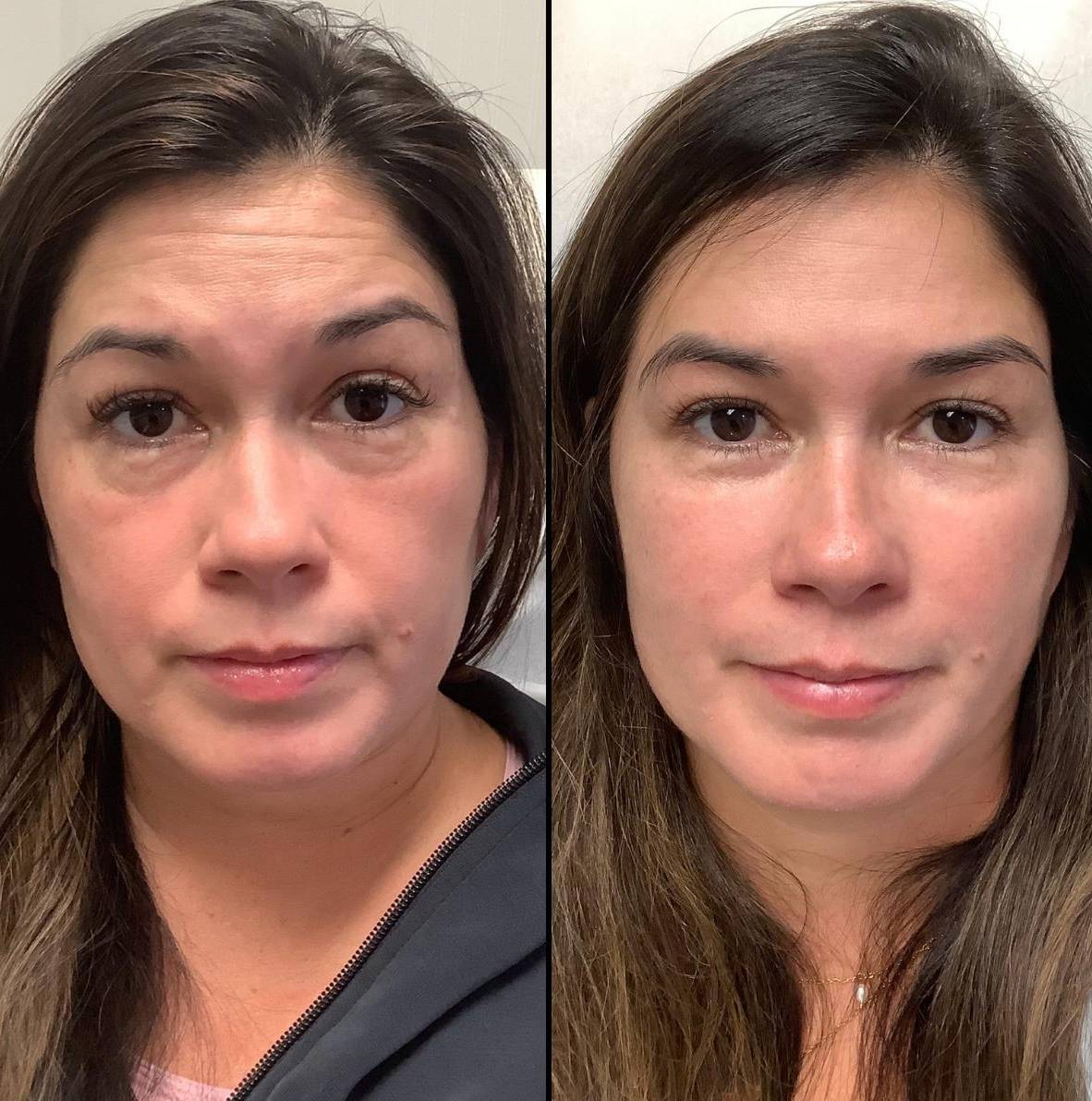 Injectables | Full Face Facial Balance | Case 1 