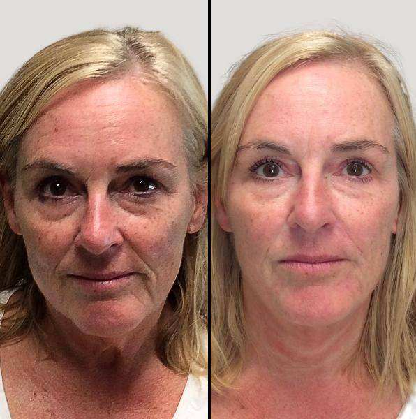 Injectables for Face | Dermal Fillers | Case 1 