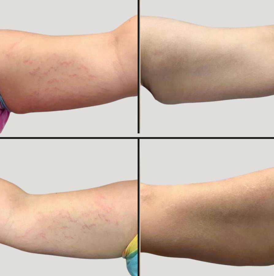 Lasers for Body | Vivace MNRF | Case 1 