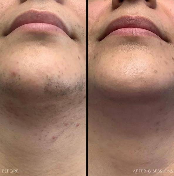 Laser Hair Removal | Case 2 