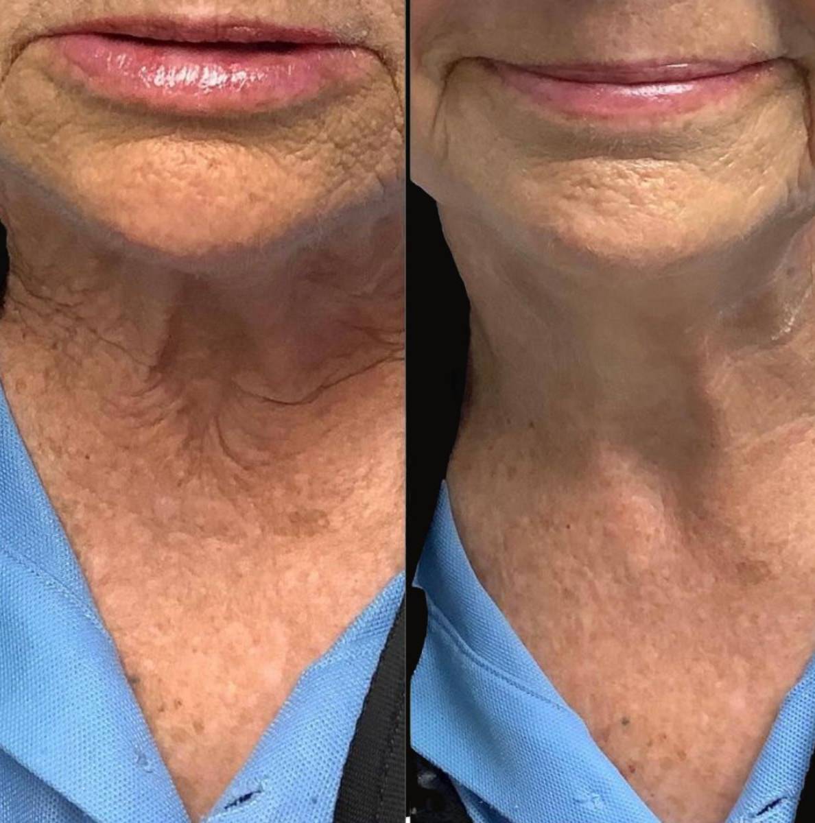 Lasers for Neck | Titan | Case 1 