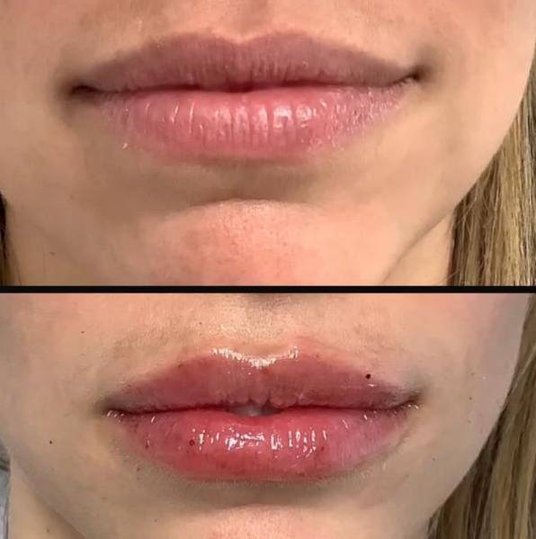 Injectables for Lips | Filler | Case 2 