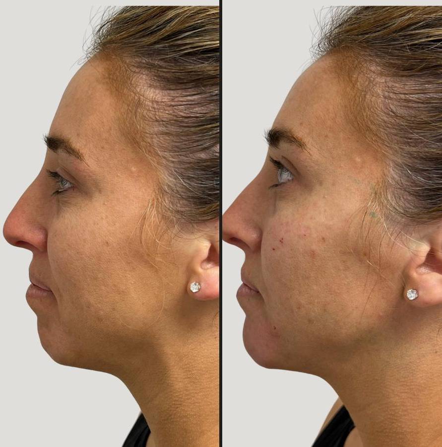 Injectables for Chin | Filler | Case 1 