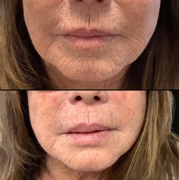 Injectable Vertical Lip Lines  | Skinvive | Case 3 