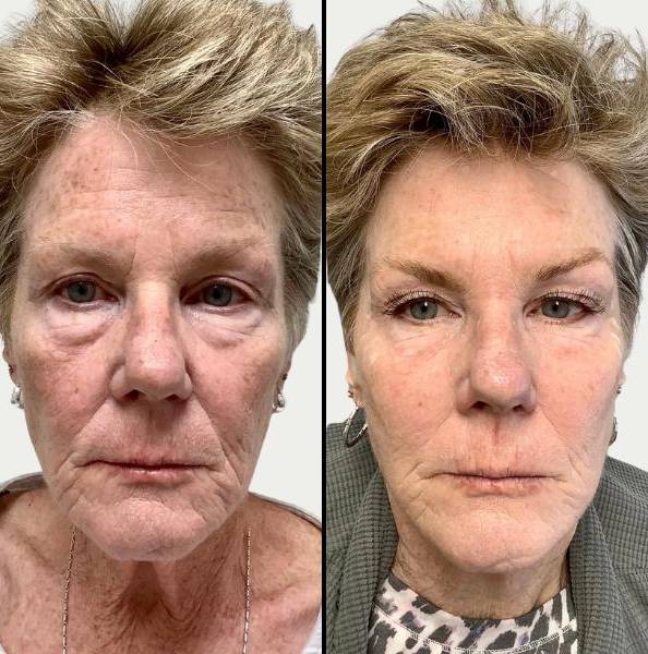 Lasers for Face | MNRF Vivace | Case 3 