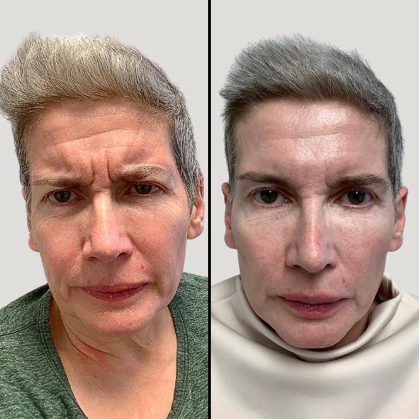 Injectables for Forehead | Botox | Case 4 