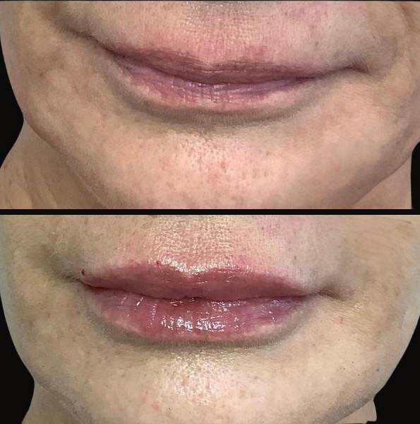 Injectables for Lips | Filler | Case 5 