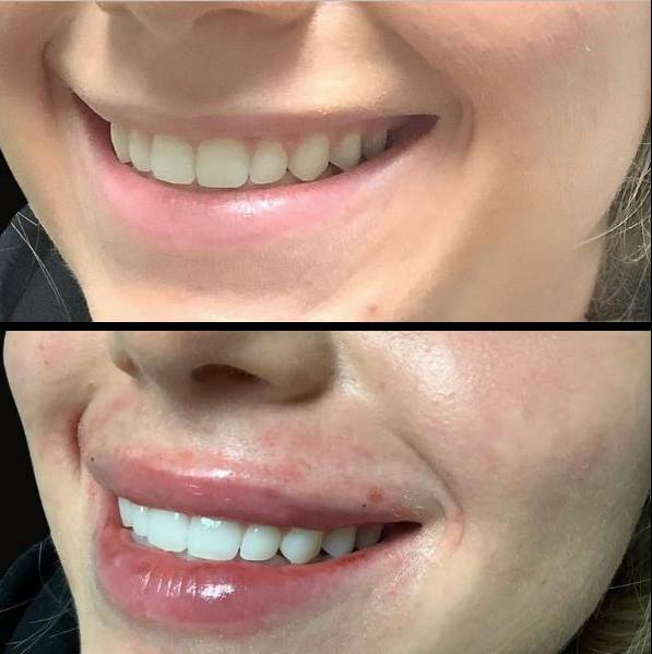 Injectables for Lips | Filler | Case 6 