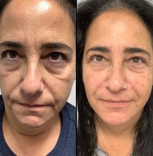 Injectables for Face | Skinvive | Case 7 