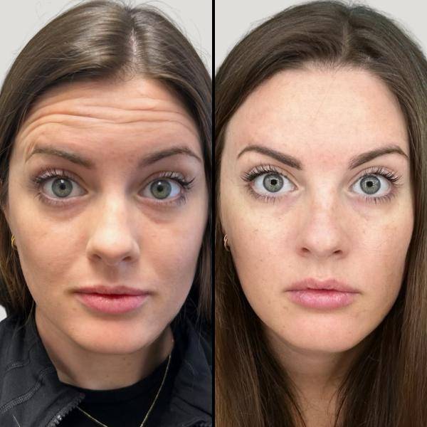 Injectables for Forehead | Botox | Case 2 