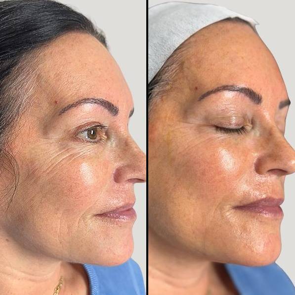 Chemical Peel | Case 7 