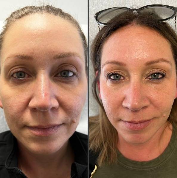 Upper and Lower Eye Lid Rejuvenation 