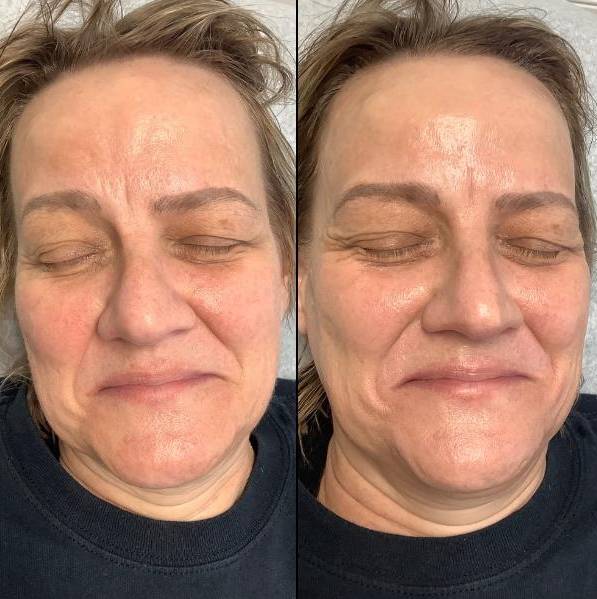 Medi Facial Case 6 | Carboxy 