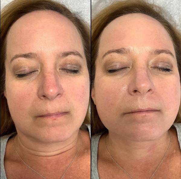 Chemical Peel Case 3 