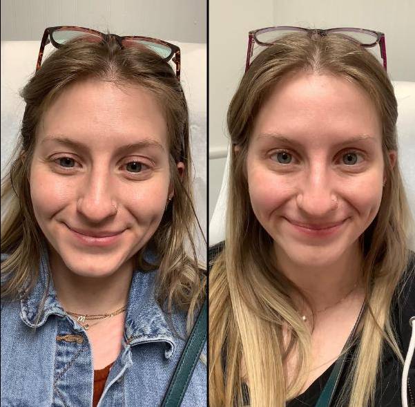 Botox to soften wrinkles 