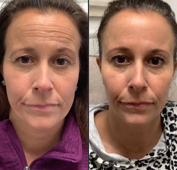 Full Face Botox, targeting forehead wrinkles 