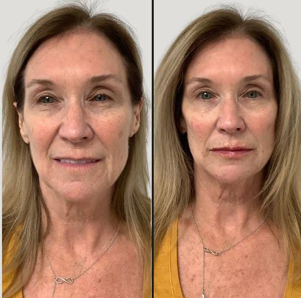 Facial Balancing with Dermal Filler 