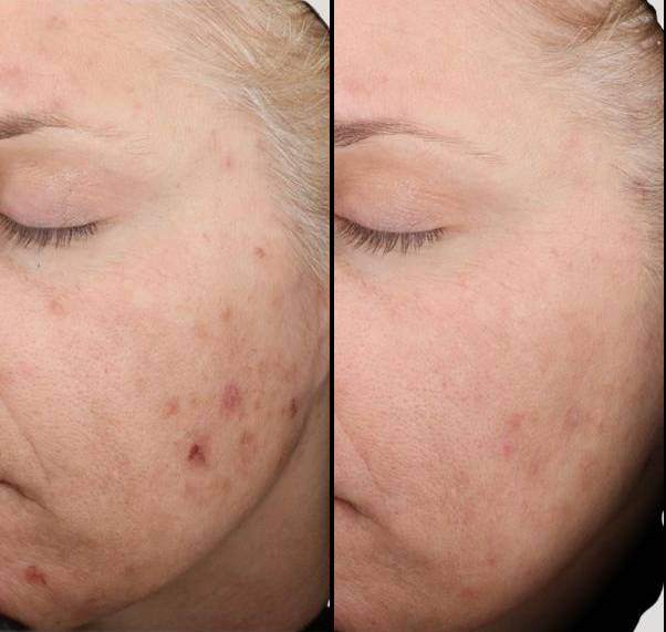 Acne Reduction 