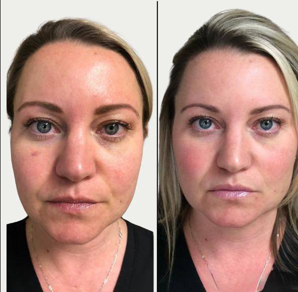 Medi Facial with Aquagold 