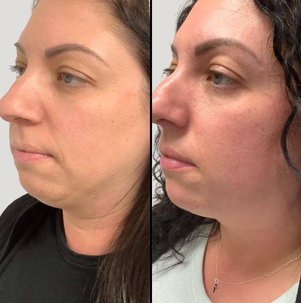 Double Chin Reduction 