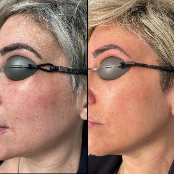 3D Laser Rejuvenation 