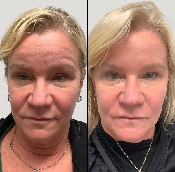 Wrinkle Reduction with Botox 