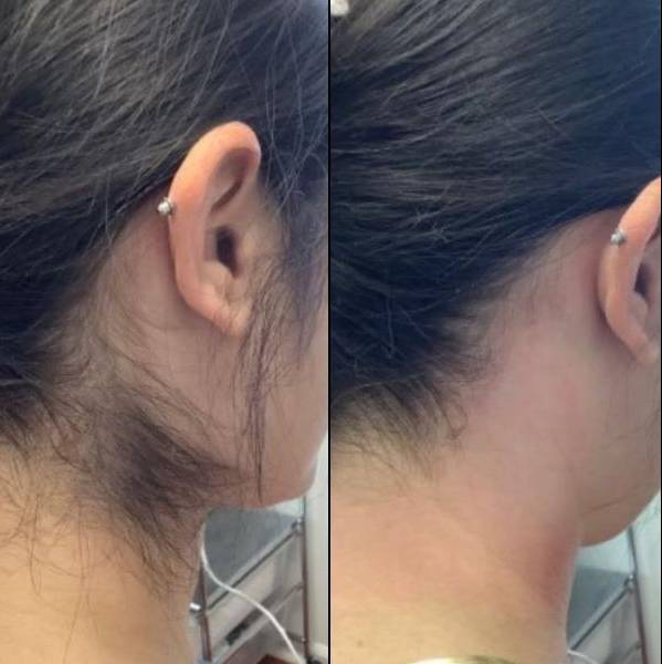 Laser Hair Removal | Case 1 