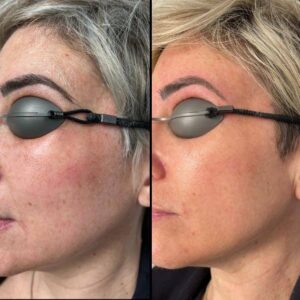 3D Laser Rejuvenation