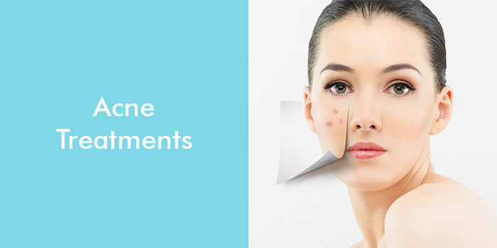 Acne Treatments