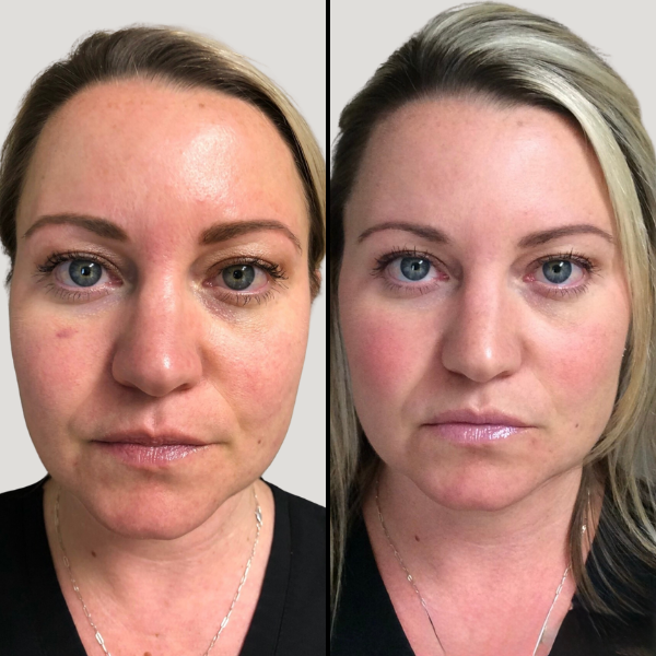 Aquagold procedure page BA