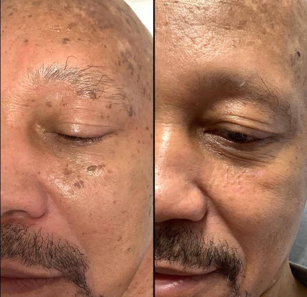 Benign Lesion Removal With Plasma Pen - left cheek