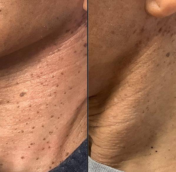 Benign Lesion Removal With Plasma Pen - neck