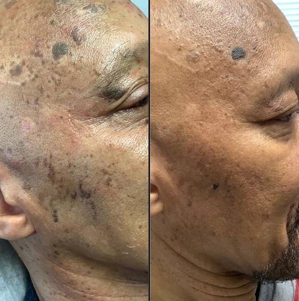 Benign Lesion Removal With Plasma Pen - right side