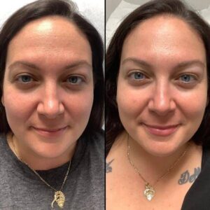 Botox Eyebrow Raise