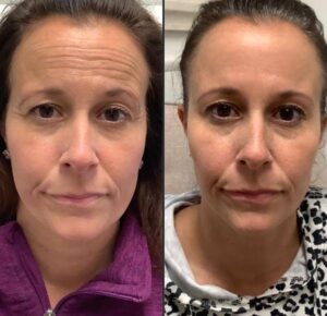 Full Face Botox, Targeting Forehead Wrinkles