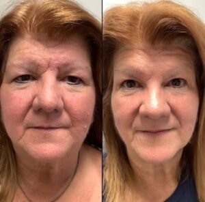 Botox \\\"11\\\" Lines | Case 9