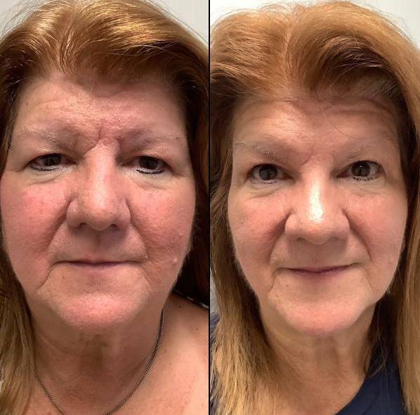 Botox \\\"11\\\" Lines | Case 9