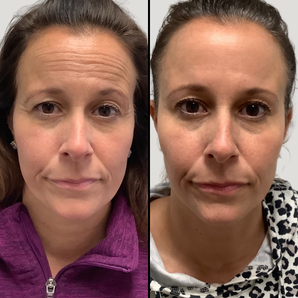 Botox procedure page BA