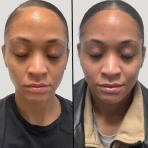 Cheek, Mid Face, Lips Enhancement