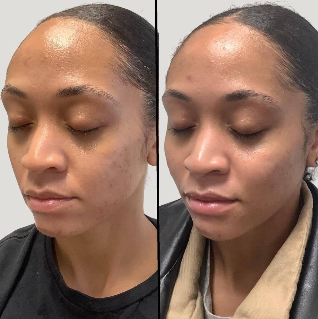 Cheek, Mid Face, Lips Enhancement