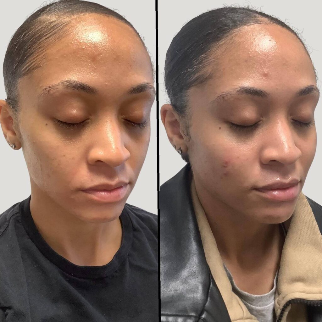 Cheek Mid Face Lips Enhancement side2 1024x1024