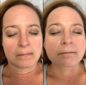 Chemical Peel Case 3