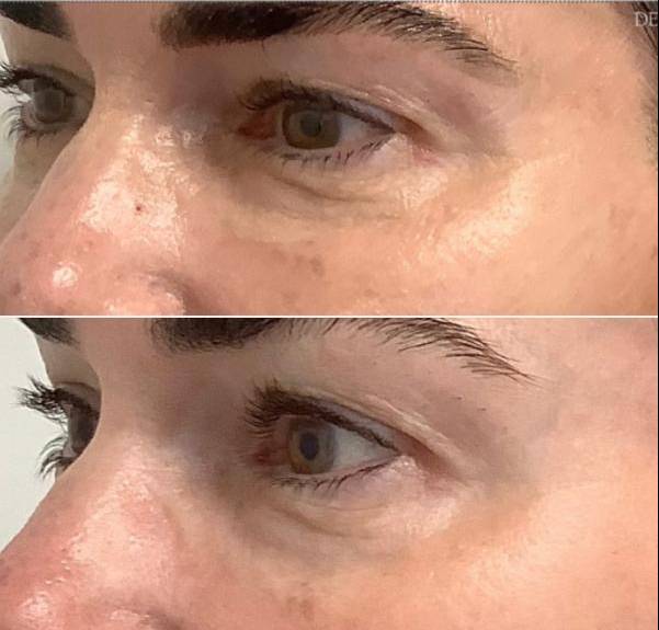 Diamond Glow | Case 2 - right eye