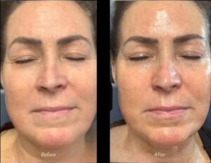 Facial Treatment | Chemical Peel | Case 2