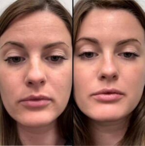 Facial Treatment | Chemical Peel | Case 1