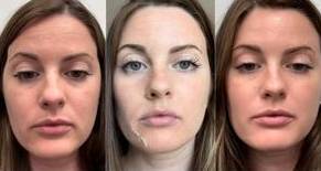 Facial Treatment | Chemical Peel | Case 1 - peel progression